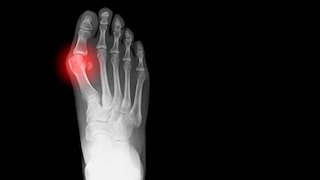 X-ray of a bunion. Find out here whether and how it and other foot deformities need to be treated.
