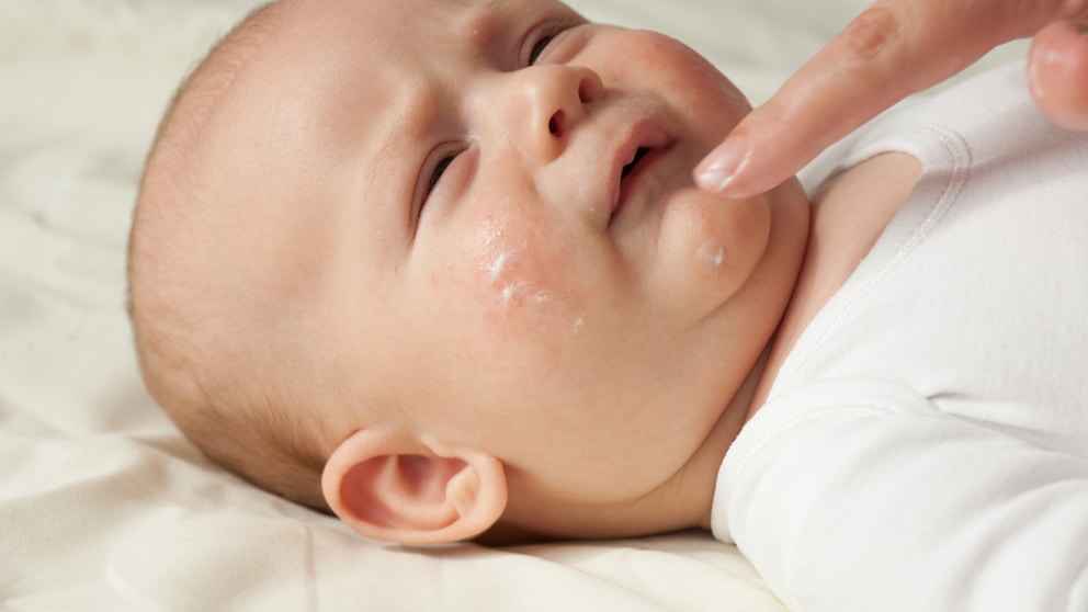 Baby With Skin Problems