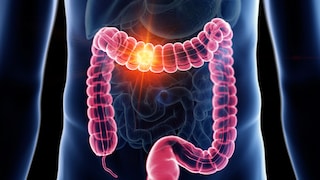 Colon Cancer in Younger Men: An Illustration of Colon Cancer