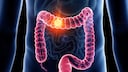 Colon Cancer in Younger Men: An Illustration of Colon Cancer