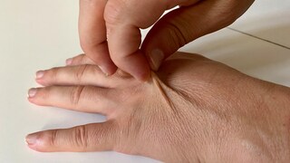 Dehydrated Skin Test
