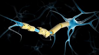 Nerve Cells in Multiple Sclerosis