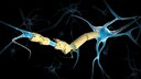 Nerve Cells in Multiple Sclerosis