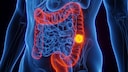 Colorectal Cancer