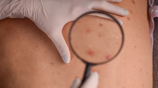 Squamous cell carcinoma is a form of nonmelanoma skin cancer