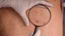 Squamous cell carcinoma is a form of nonmelanoma skin cancer