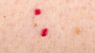 What do red spots on the skin mean?