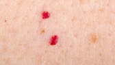 What do red spots on the skin mean?