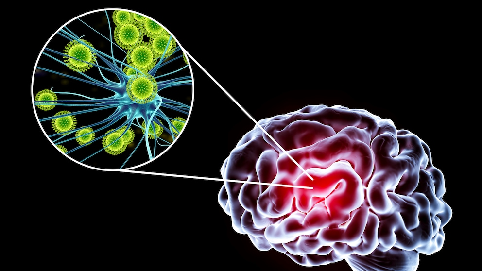 Encephalitis (inflammation of the brain)