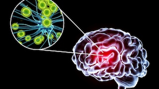 Encephalitis (inflammation of the brain)