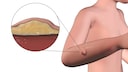 Lipoma