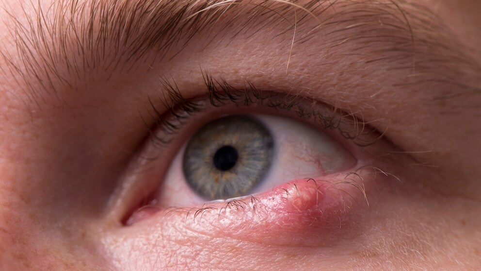If you have it, you only want one thing: to get rid of the sty again