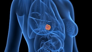 Breast Cancer in Women