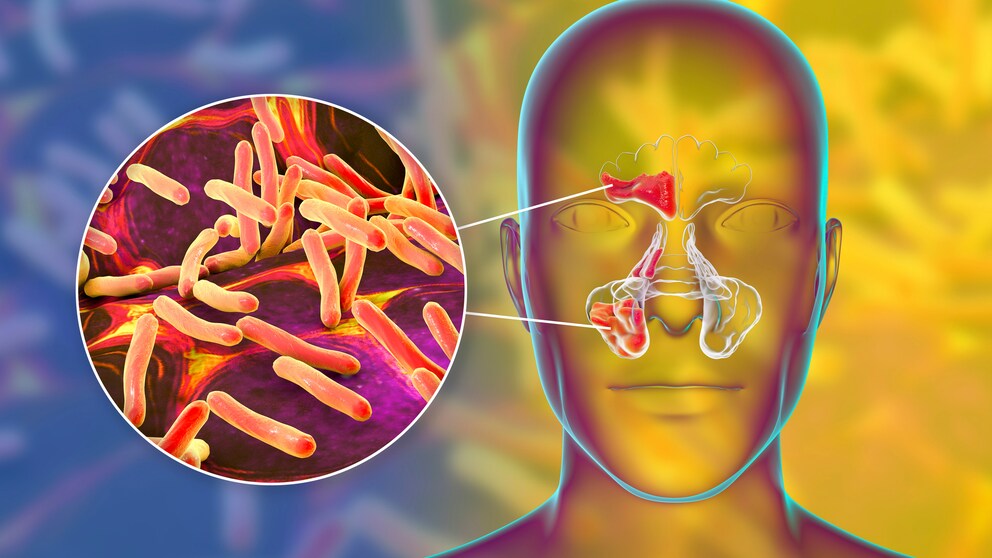 Symptoms, causes and treatment of sinusitis (inflammation of the paranasal sinuses)