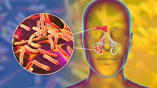 Symptoms, causes and treatment of sinusitis (inflammation of the paranasal sinuses)