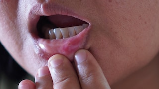 Aphthae can be a real pain.