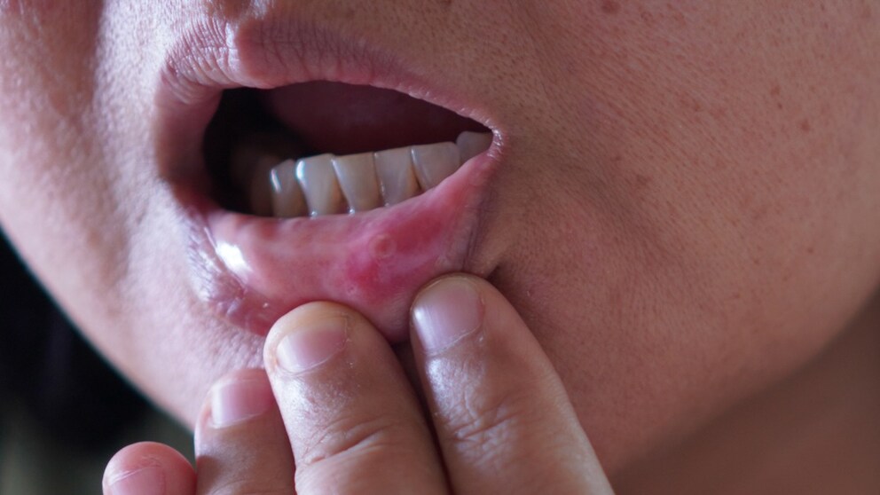 Aphthae can be a real pain.
