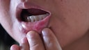 Aphthae can be a real pain.