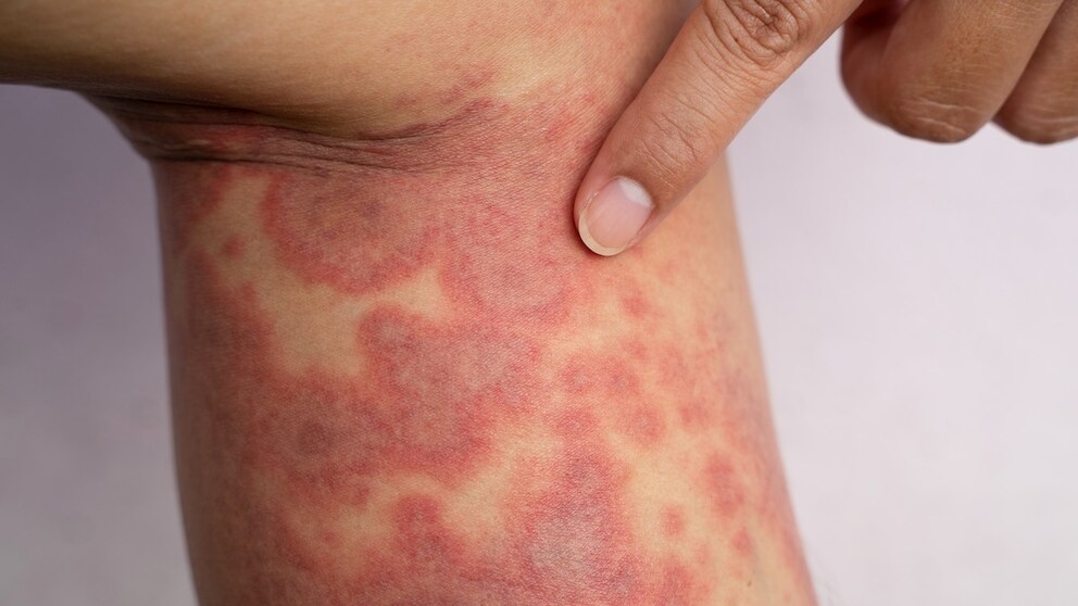 Severe skin disease