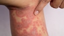 Severe skin disease