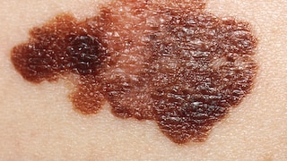Apparently there is a link between the consumption of fish and skin cancer