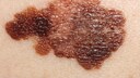 Apparently there is a link between the consumption of fish and skin cancer