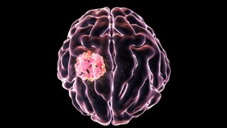 Glioblastoma