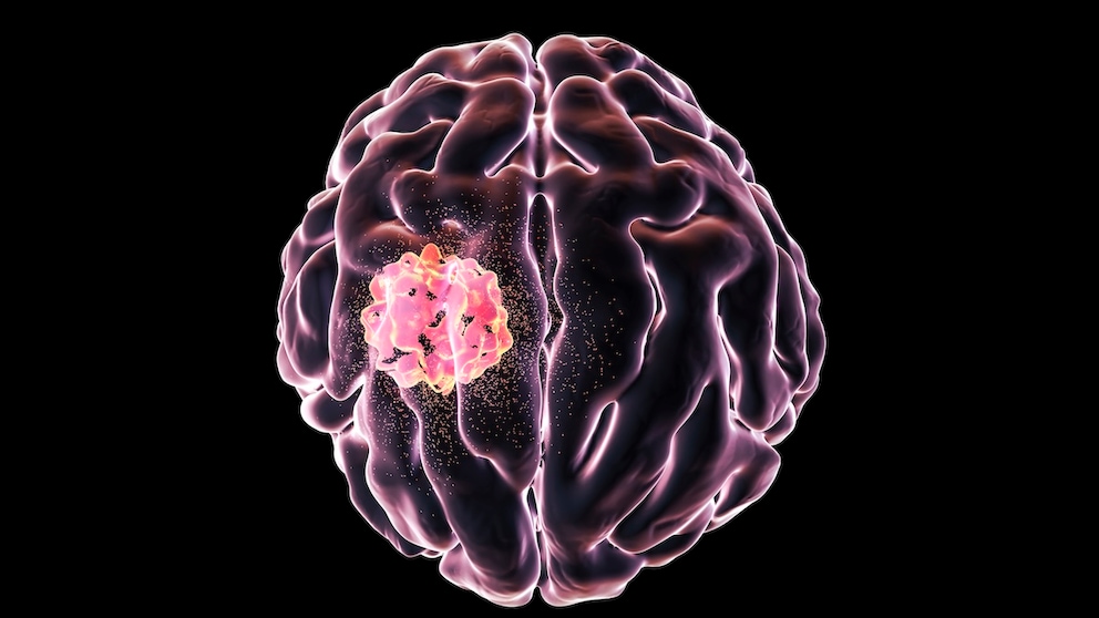 Glioblastoma