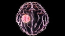 Glioblastoma
