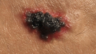 Tumor thickness determines the chance of survival in skin cancer