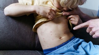 A young child with chickenpox