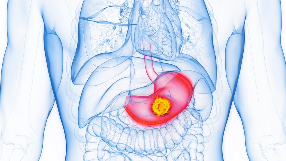 Stomach cancer
