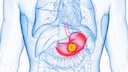 Stomach cancer