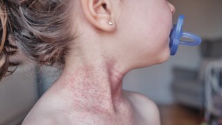 Neurodermatitis in a child