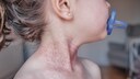 Neurodermatitis in a child