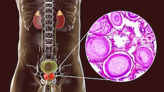 Prostate cancer