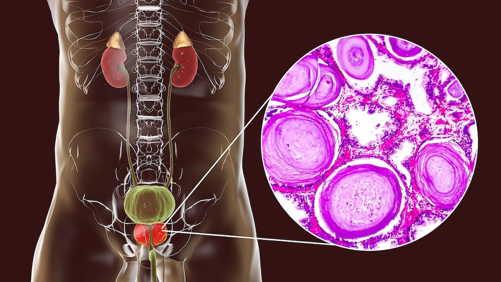 Prostate cancer