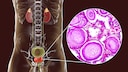 Prostate cancer