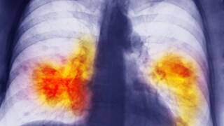 Lung cancer