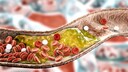 Arteriosclerosis