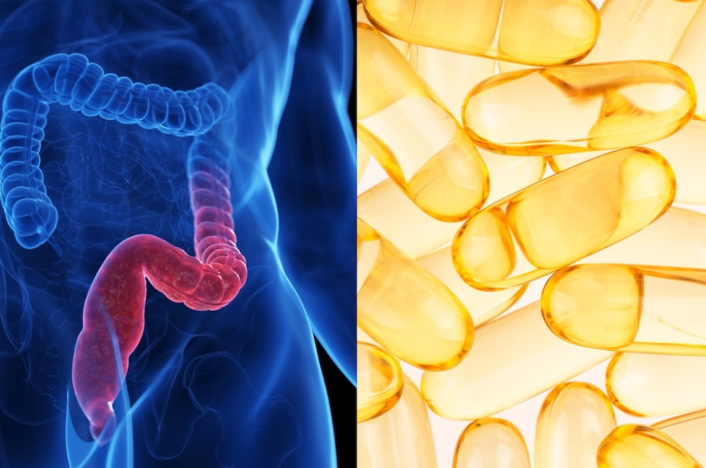 Ulcerative Colitis: Vitamin D Can Help Alleviate Symptoms- FITBOOK