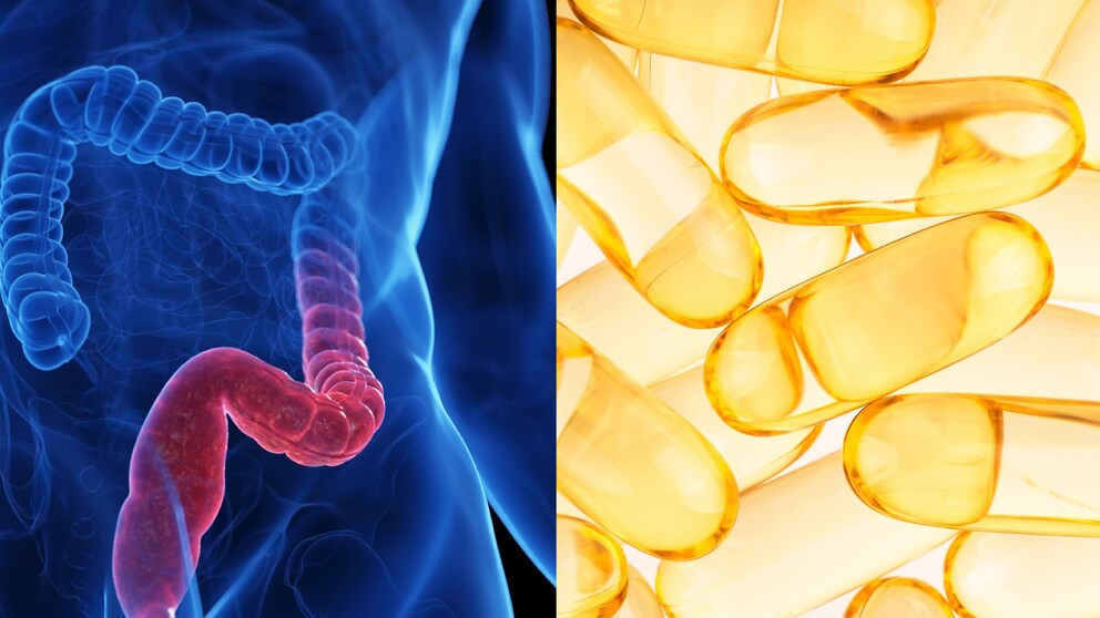 How vitamin D can help alleviate ulcerative colitis symptoms