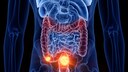 Colorectal cancer
