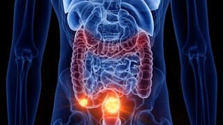 Calcium may protect against bowel cancer