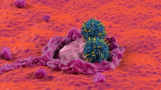 Colorectal cancer