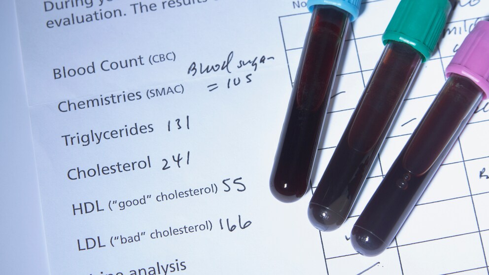 Cholesterol values in laboratory analysis