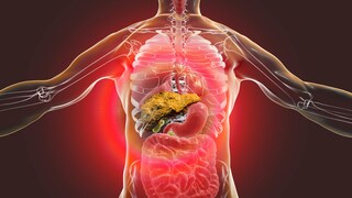 Liver cirrhosis