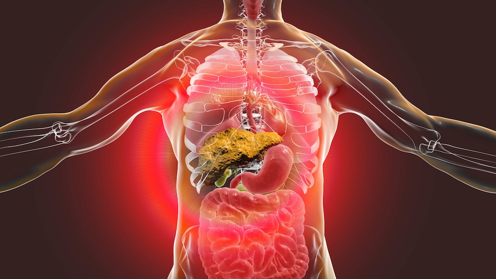 Liver cirrhosis