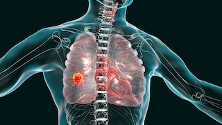 Diet has an influence on lung cancer