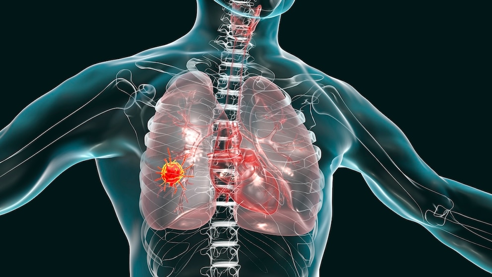 Diet has an influence on lung cancer